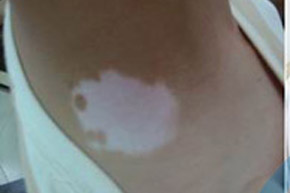 白癜风的危害表现有哪些